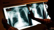 New TB test could save hundreds of thousands of children: scientists